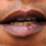 How To Get Rid Of A Cold Sore And What Causes It?