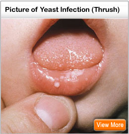 how to get rid of a yeast infection