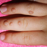 How to Get Rid of Warts