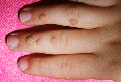 how to get rid of warts