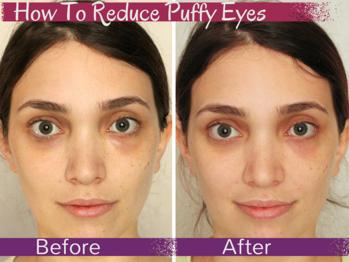 Treat-Puffy-Eyes-Before-After