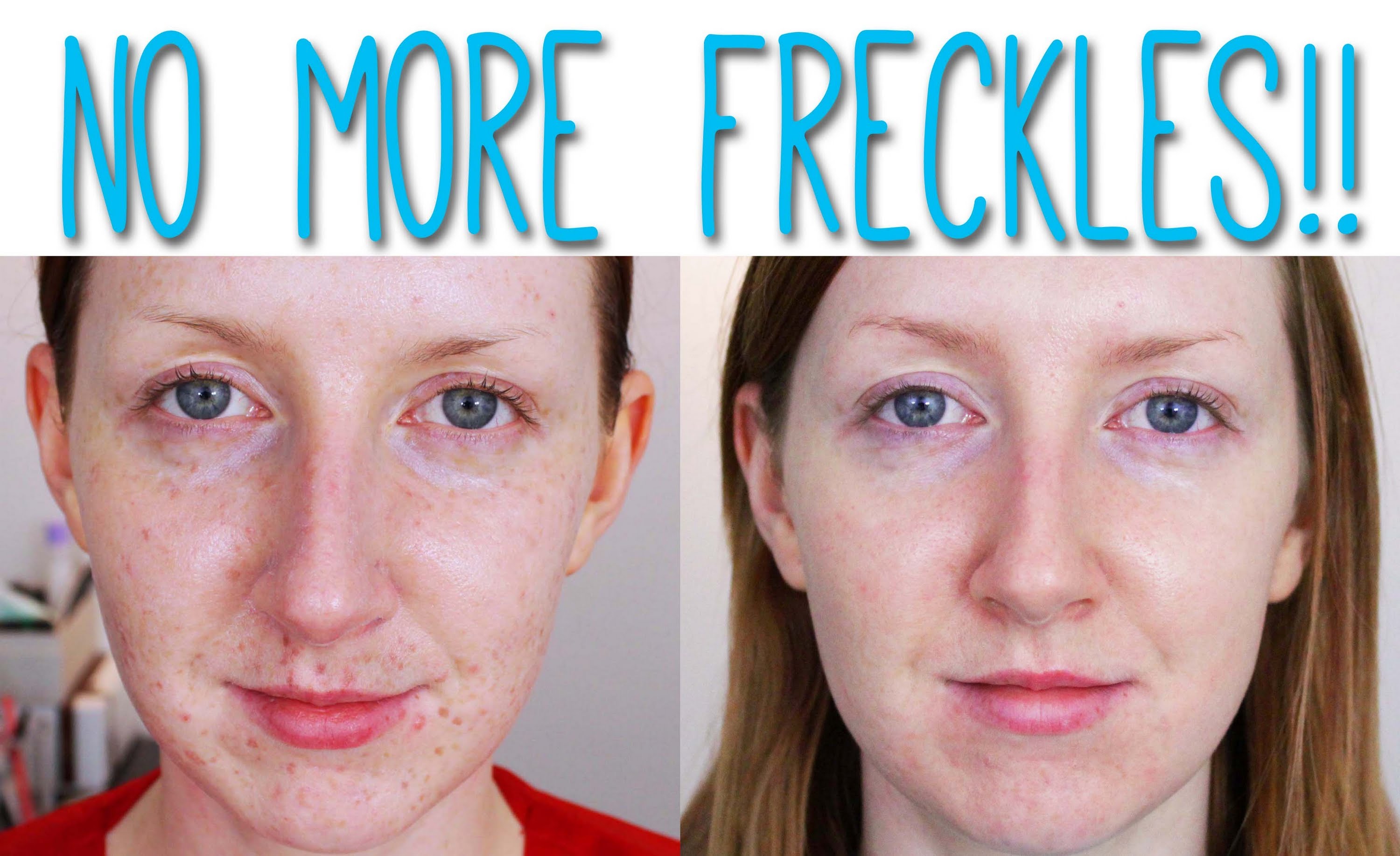 get-rid-of-freckles-on-the-face