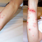 Ways How To Get Rid Of Poison Ivy When You Contracted One