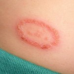 How to Get Rid of Ringworm of the Skin – Causes, Symptoms and Treatments