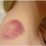 Discover the Effective Ways on How to Get Rid of Bruises