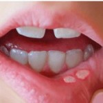 How to Get Rid of Canker Sores