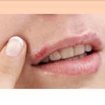 How to Get Rid of Cold Sores