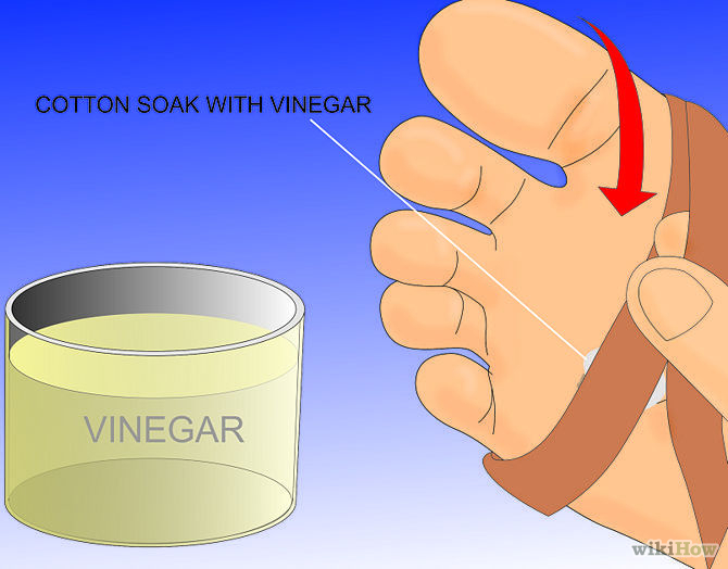 Get-Rid-of-a-Wart-at-the-Bottom-of-Your-Foot-Step-6