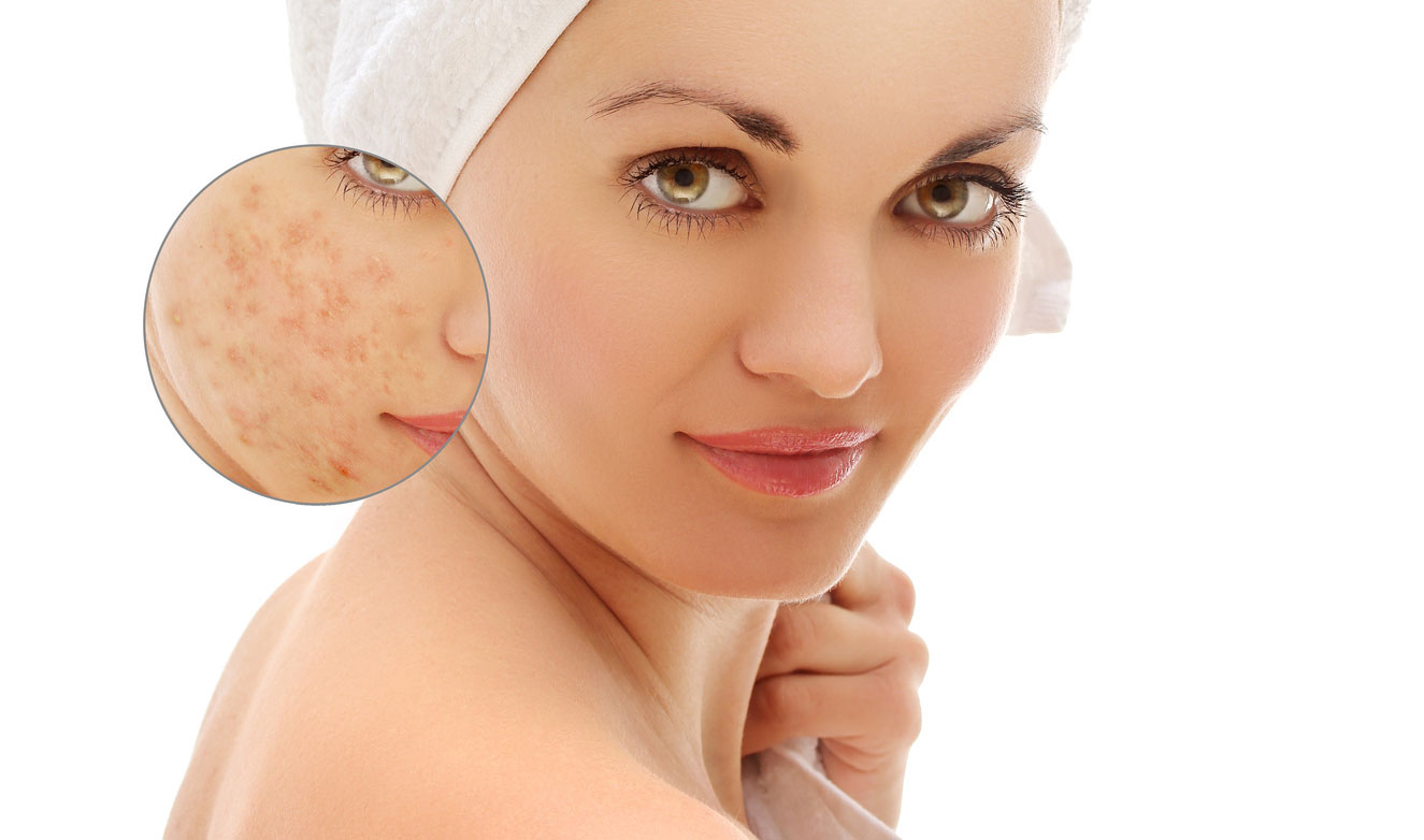 Eczema-Scars-on-Face